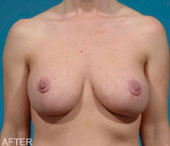 Patient # 69446 After Photo # 2